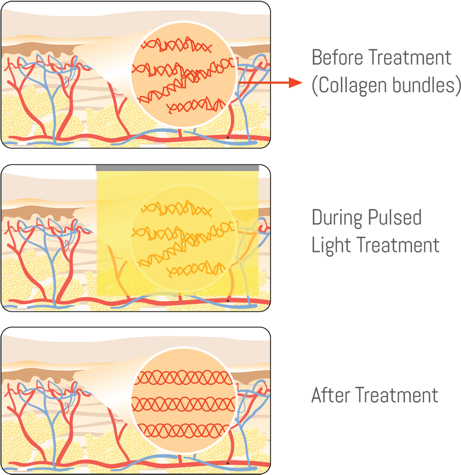Download Laser Skin Tightening Exeter Medical Before, During