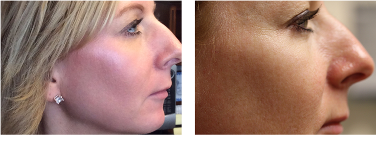 Suttonderm Beforeaftergallery Fraxel2 - Scar (826x348), Png Download