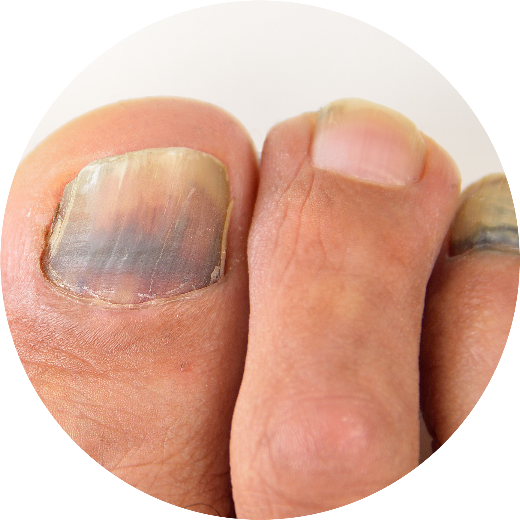 Subungual Nail Circle (1733x1733), Png Download