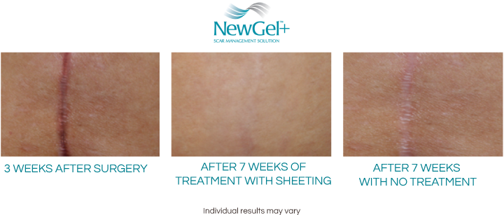 While Scars Vary Greatly In Every Aspect, Depending - Newgel+ Silicone Gel For Scar Management - 8" Abdomen/c-section (801x401), Png Download
