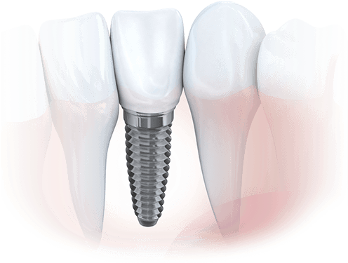 Animation Of Implant Supported Dental Crown - Dental Implant (526x385), Png Download