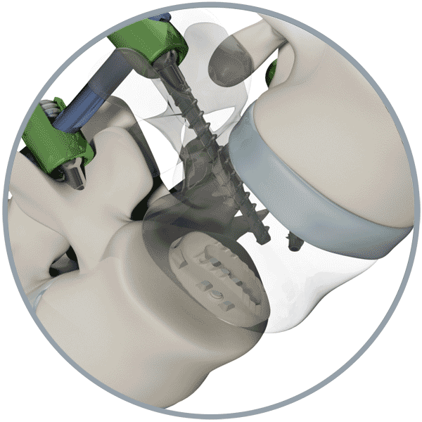 Spinal Spacer System - Novel (600x600), Png Download