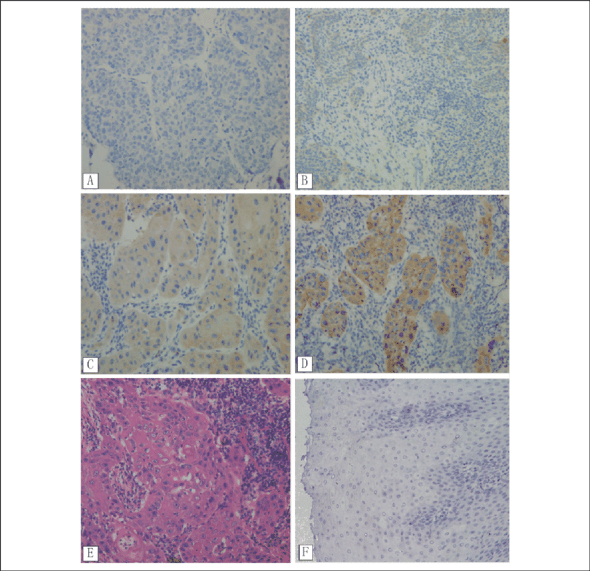 Immunohistochemistry Analysis Of Mtor Expression In - Tile (850x823), Png Download