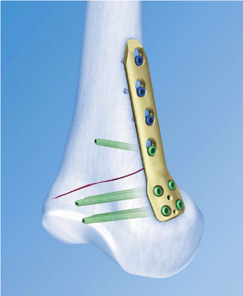 Tomofix Medial Distal Femur Plate (838x606), Png Download