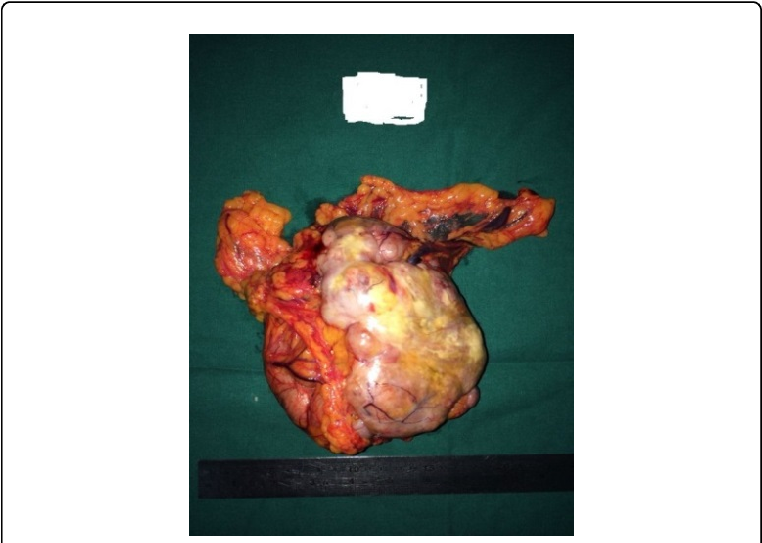 Gross Picture Of The Tumour - Low Grade Endometrial Stromal Sarcoma (769x546), Png Download
