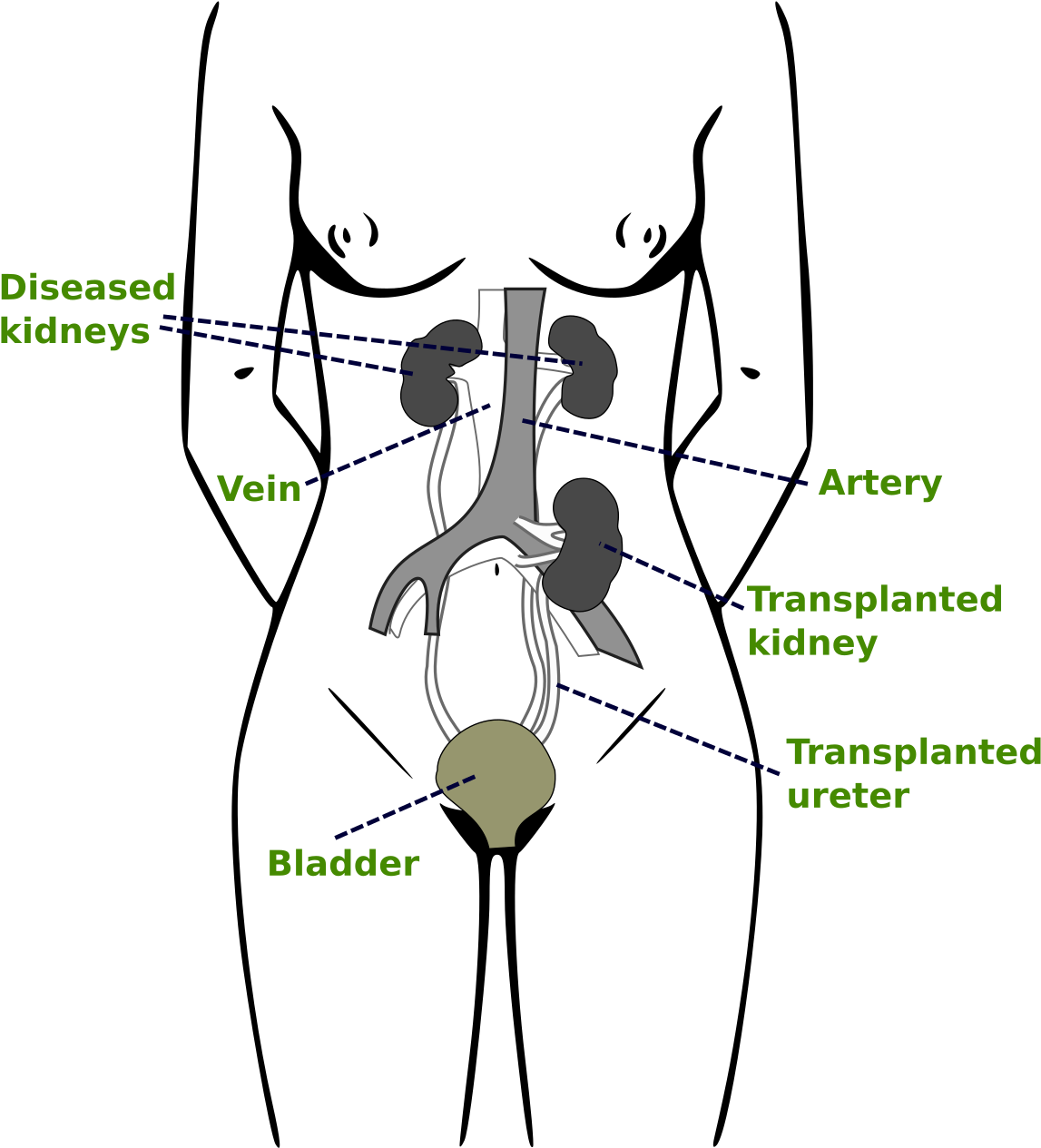 Kidney Transplantation Pdf (1200x1318), Png Download