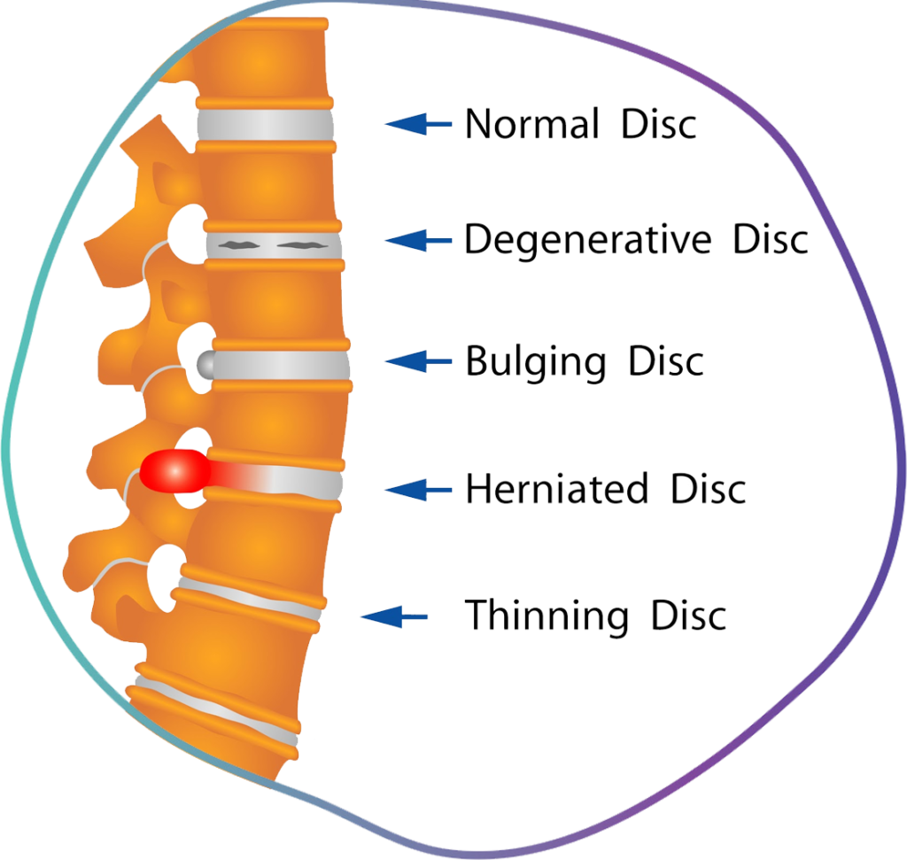 Download Degenerative Disc Disease - Disc Spine - Full Size PNG Image ...