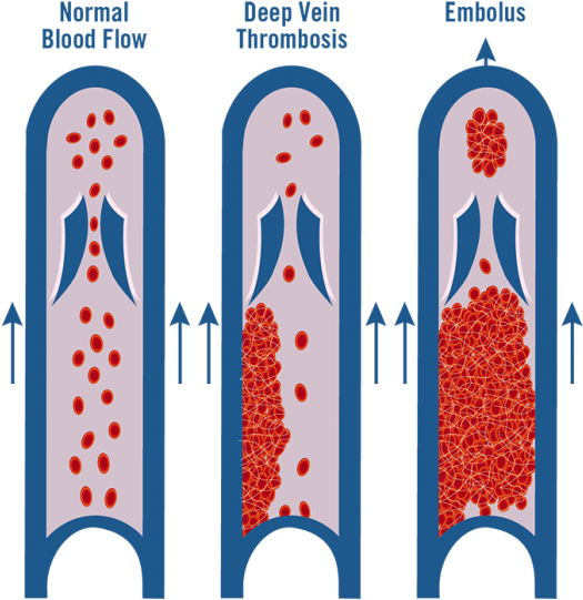 Vein Healthcare Center - World Thrombosis Day 2017 (543x600), Png Download