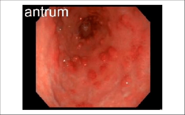 Endoscopy Showing Erythematous Gastric Nodules In The - Erythematous Patches In Stomach (724x449), Png Download