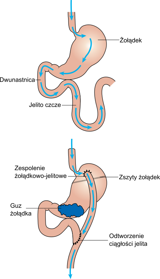 Diagram Showing Before And After Stomach Bypass Surgery - Antrum Żołądka Gdzie (517x898), Png Download