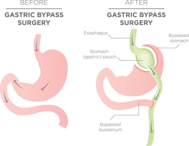 The Upper Is Bypassed Directly To The Small Intestine - Gastric Bypass (768x593), Png Download