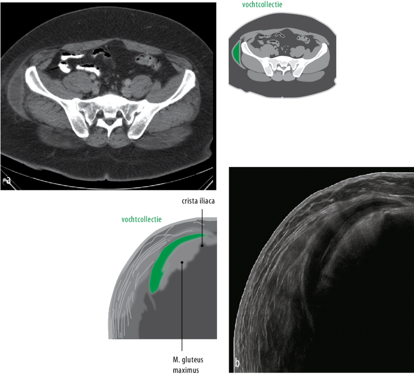 Figuur 1 Een Transversale Ct-coupe Van Het Abdomen - Computed Tomography (850x777), Png Download