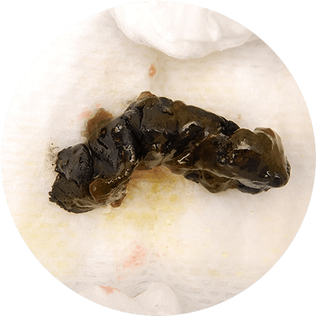 Download Discover What Causes Black Baby Poop With The Similac® - Black