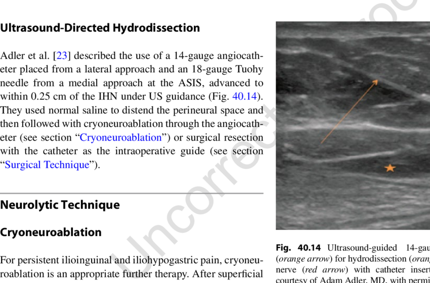13 Ultrasound Image Of The Ilioinguinal And Iliohypogastric - Ilioinguinal Nerve Ultrasound Nerves (850x560), Png Download