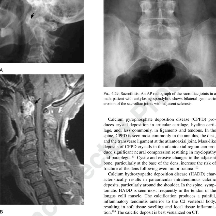 A Lateral Radiograph Shows Widening Of The Atlantoaxial - Atlantoaxial Joint Rheumatoid Arthritis (850x852), Png Download