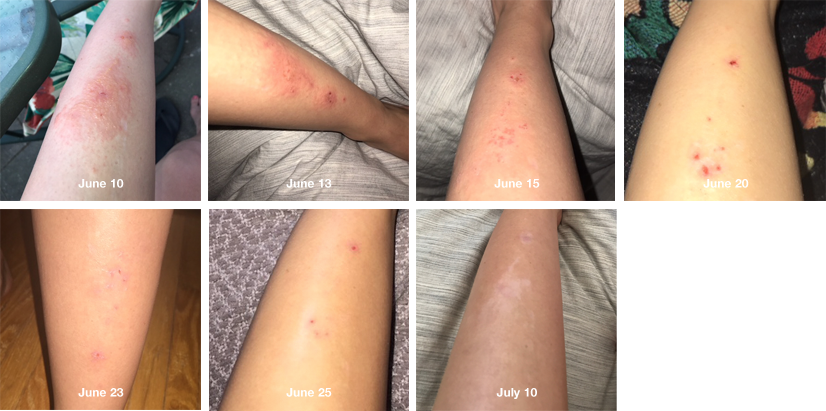 This Is My Leg Now From The Poison Ivy - Health Care (826x411), Png Download