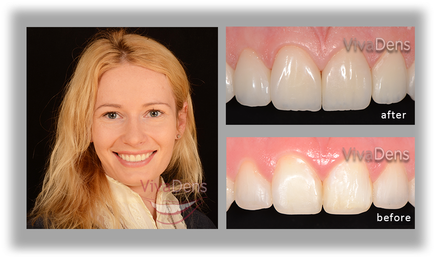 Why To Choose Direct Aesthetic Restoration Procedure - Tooth Bleaching (901x532), Png Download