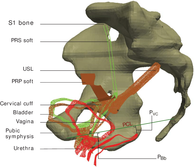 Sagittal Slices Measuring The Bladder Base And The - Pectopexy (680x578), Png Download