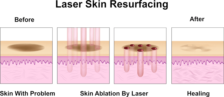 Acne Sometimes Feels Like A Double Punishment- First - Icon 1540 Fractional Laser (716x311), Png Download