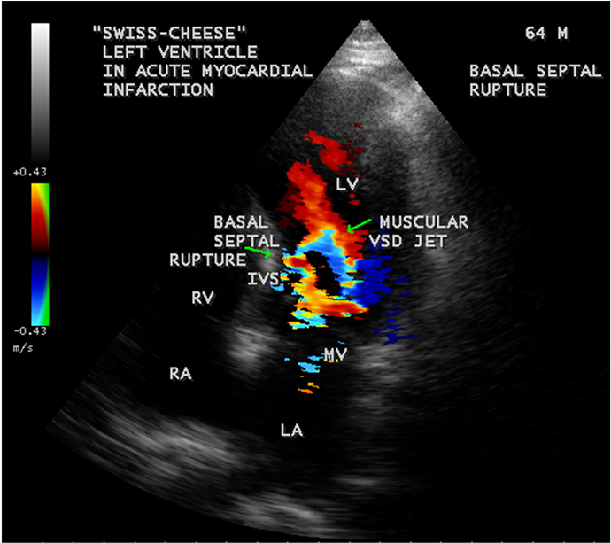 Apical Four Chamber View Showing The Basal Septal Rupture - Muscular Vsd Swiss Cheese (903x612), Png Download