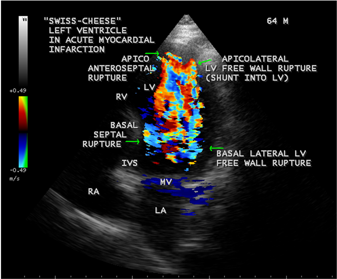 Apical 4 Chamber View Showing The “swiss-cheese” Left (903x563), Png Download