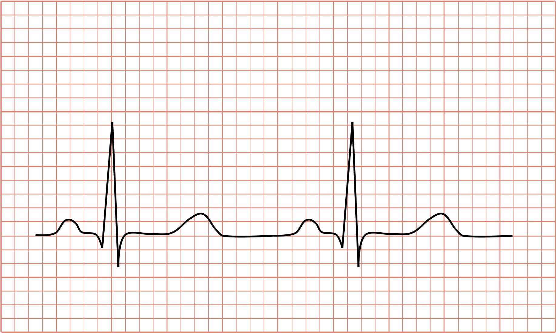 Open - Normal Ecg (2000x1185), Png Download