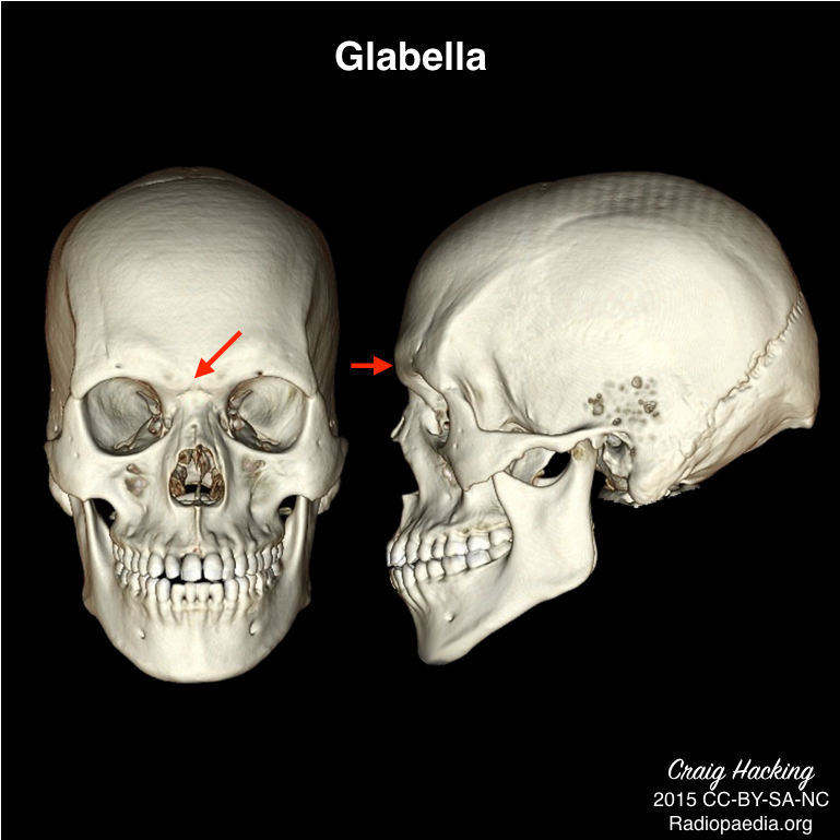 Radiology Quiz 40462 - Nasion Skull (1024x768), Png Download