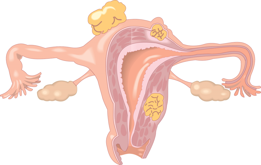 Signs Of Endometriosis - Fertility Disorder (1024x650), Png Download