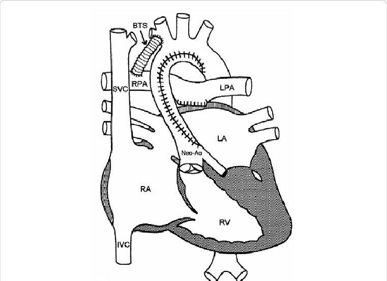In Stage I, Norwood Procedure, The Pulmonary Artery (761x553), Png Download