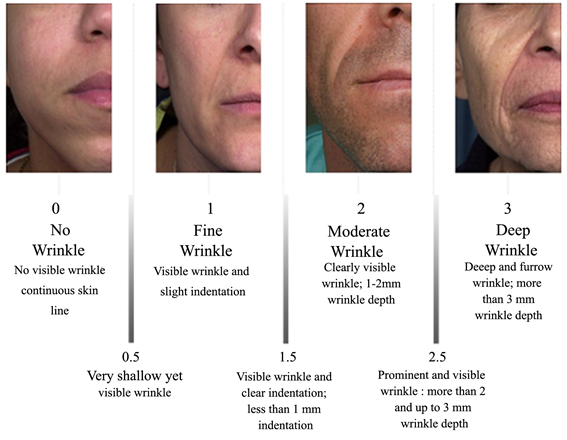 Reference Photographs Of The Four Main Classes For - Fitzpatrick Wrinkle Scale (902x439), Png Download