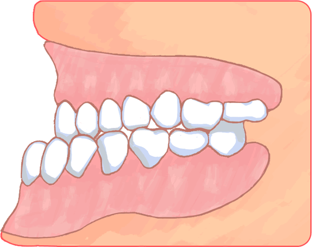 Download Mouth With A Protruding Lower Lip And Jaw Prognathism Full