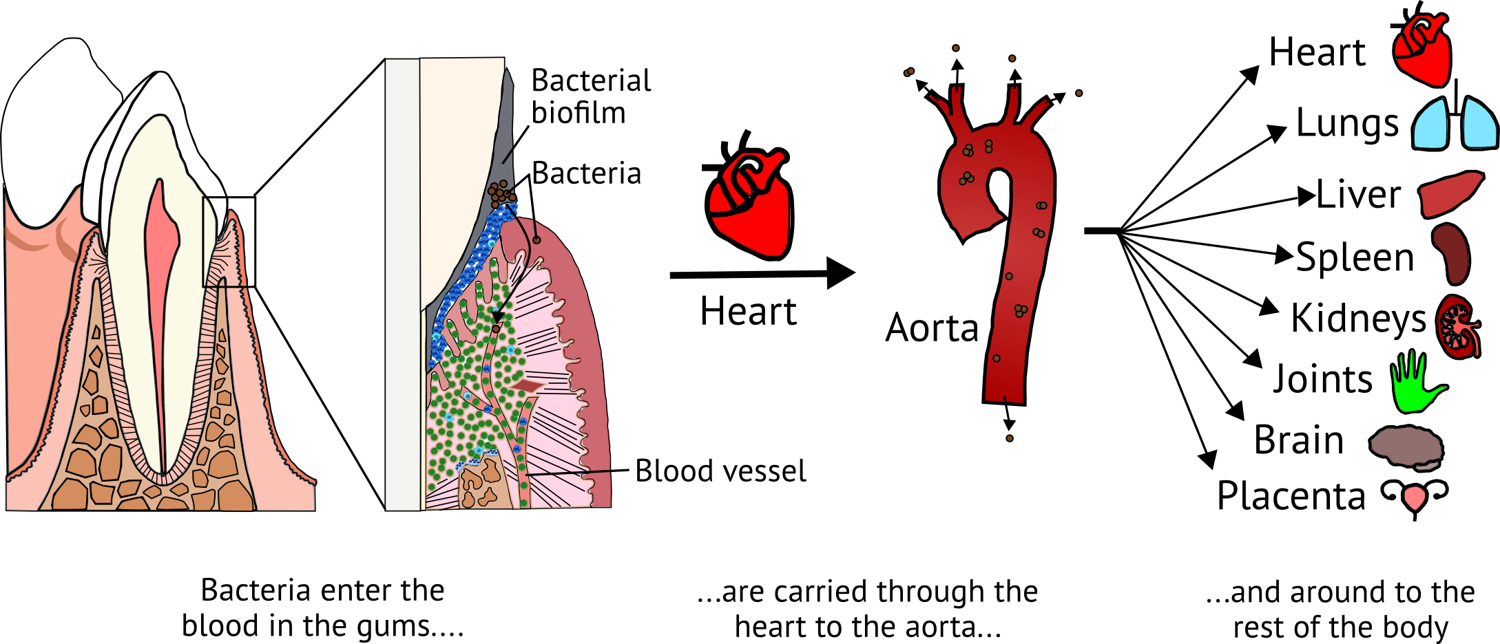 Oral Bacteria Systemic Diseases (2178x936), Png Download