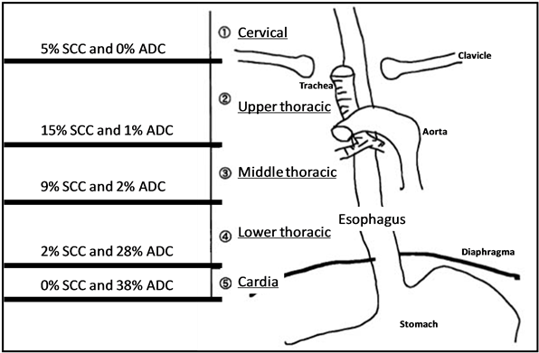 Incidence And Location Of The Two Types Of Esophageal - Diagram (903x394), Png Download