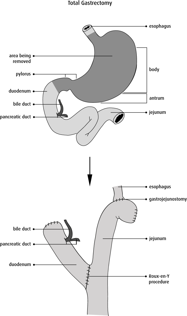 Lymph Node Dissection - Diagram (744x1258), Png Download
