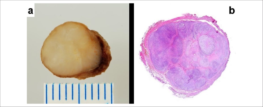 A) Tumor Is Solid, Well Circumscribed, And Yellow Tan - Lobulation (850x347), Png Download