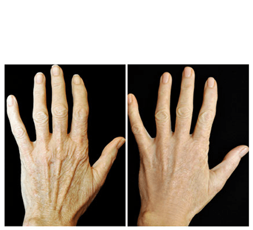 Before And After Treatment With Radiesse® Hands - Thermage Hands Before After (900x500), Png Download