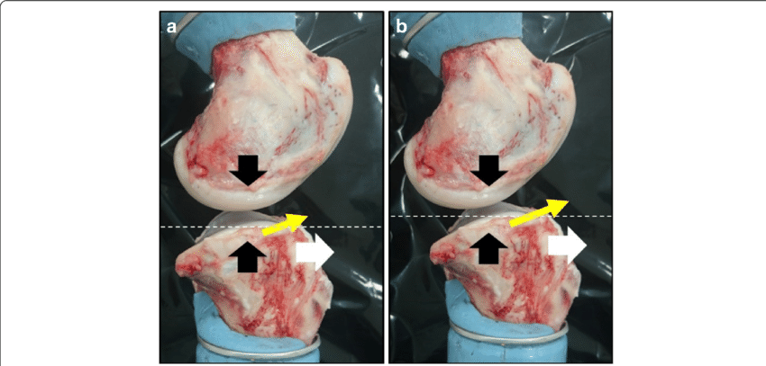 Lateral View Of Porcine Knee Joint - Varus Deformity (850x407), Png Download