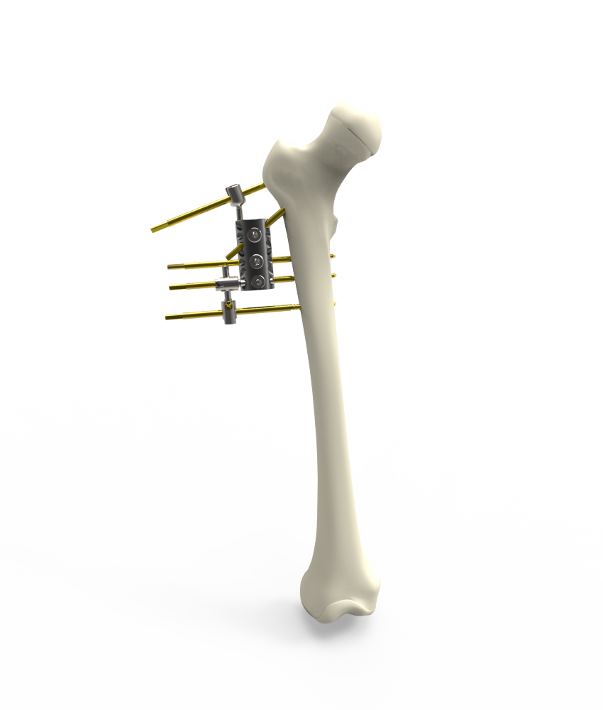 The Fixator Allows 360 Degree Rotational Motion, Flexion - Trumpet (850x1000), Png Download