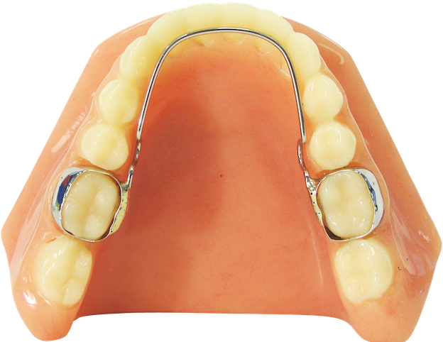 Nance Appliance - Llha Orthodontic Appliance (623x500), Png Download