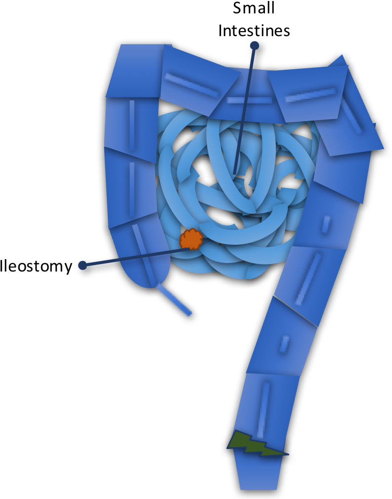 Loop Ileostomy Is A Temporary Diversion Of Stool Out - Ileostomy (808x1030), Png Download