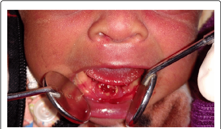 Extracted Natal Teeth Resembling Immature Teeth Download (769x449), Png Download