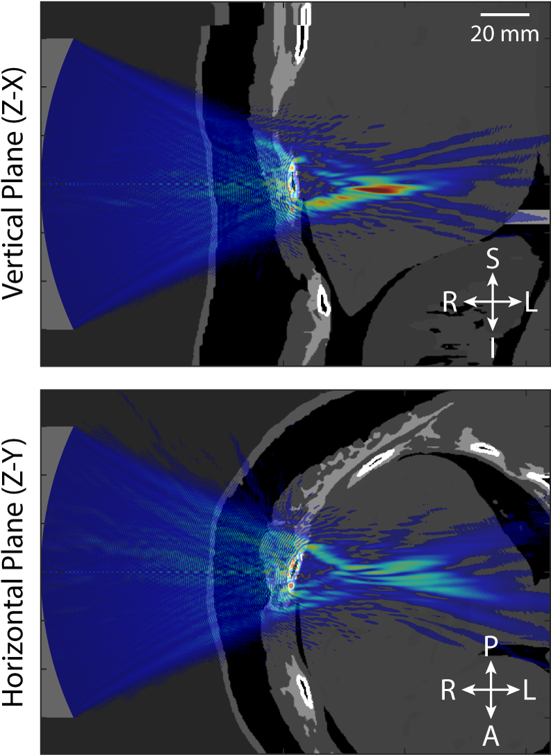 Ultrasound Beam Distortion (800x1090), Png Download