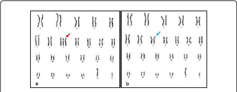 Karyotype 47,xy, 8 , B - Karyotype (769x298), Png Download