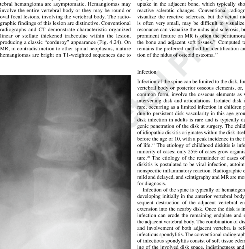 A Lateral Radiograph Of The Lumbar Spine In A 28 Year (850x865), Png Download