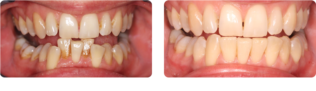 Fast Braces 4 Months (1024x304), Png Download