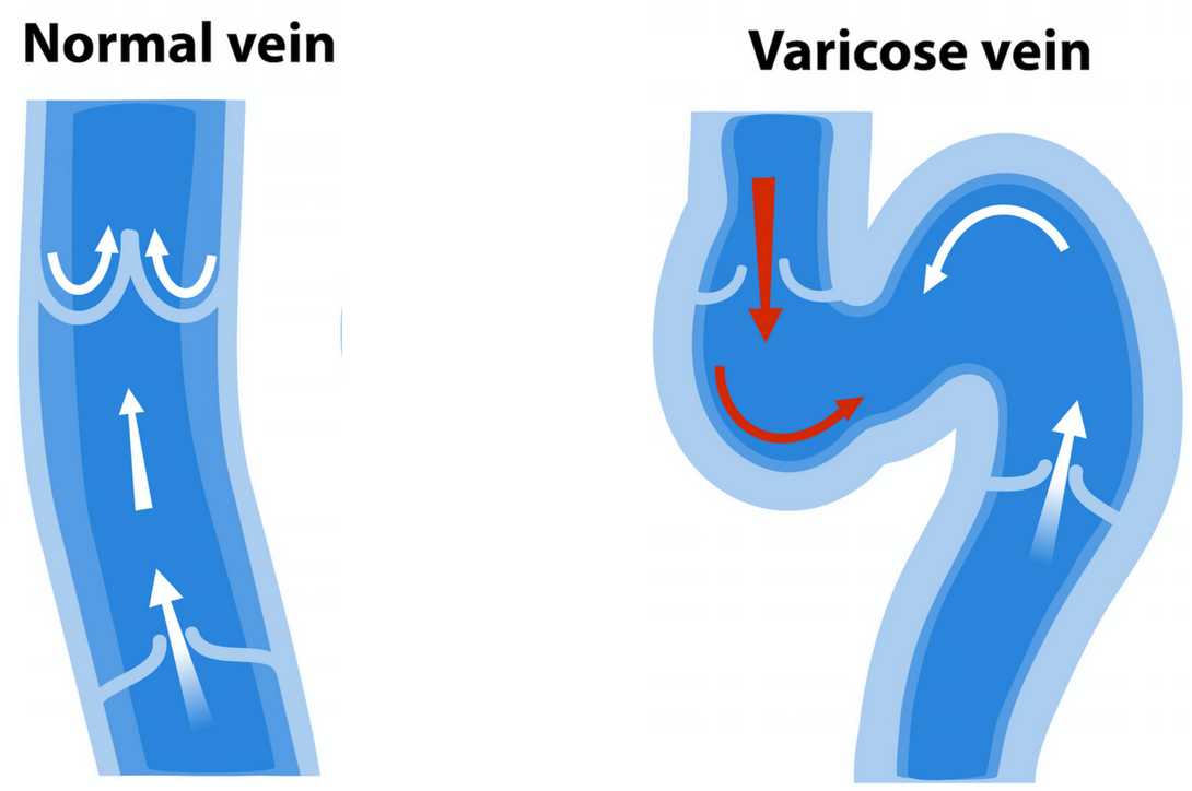 Get Rid Of Varicose Vein Symtoms By Dr - Vein (1400x800), Png Download