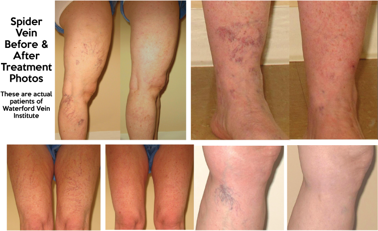 Spider Veins - Scar (792x504), Png Download