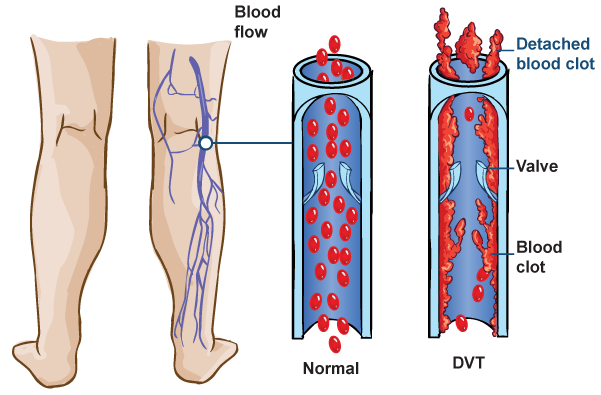 Deep Vein Thrombosis Is The Formation Of A Blood Clot - Dvt Location In Leg (601x395), Png Download