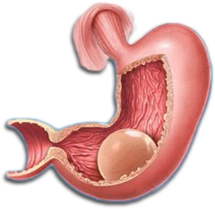 Gastric Balloon (388x429), Png Download