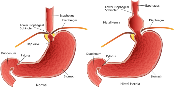 Our Stomach Is An Amazing Organ But It Has An Achilles - Hiatal Hernia (740x380), Png Download